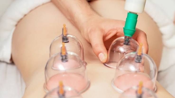 Therapist applying glass cupping cups on patient's back